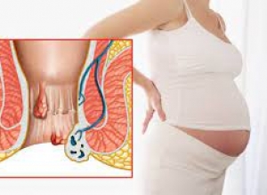 Mẹo chữa bệnh trĩ sau sinh hiệu quả dành cho mẹ bầu
